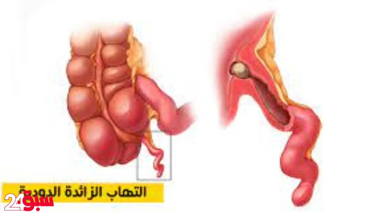 التهاب الزائدة الدودية: أعراض خطيرة تظهر على جسمك قبل انفجارها بساعات